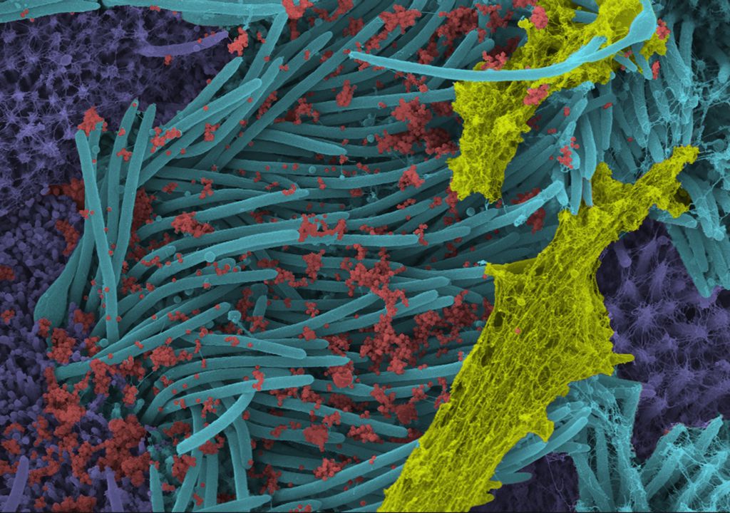 Laboratório dos Estados Unidos registra momento de infecção de uma célula pelo coronavírus (Imagem: Reprodução/Ehre Lab/UNC School of Medicine)