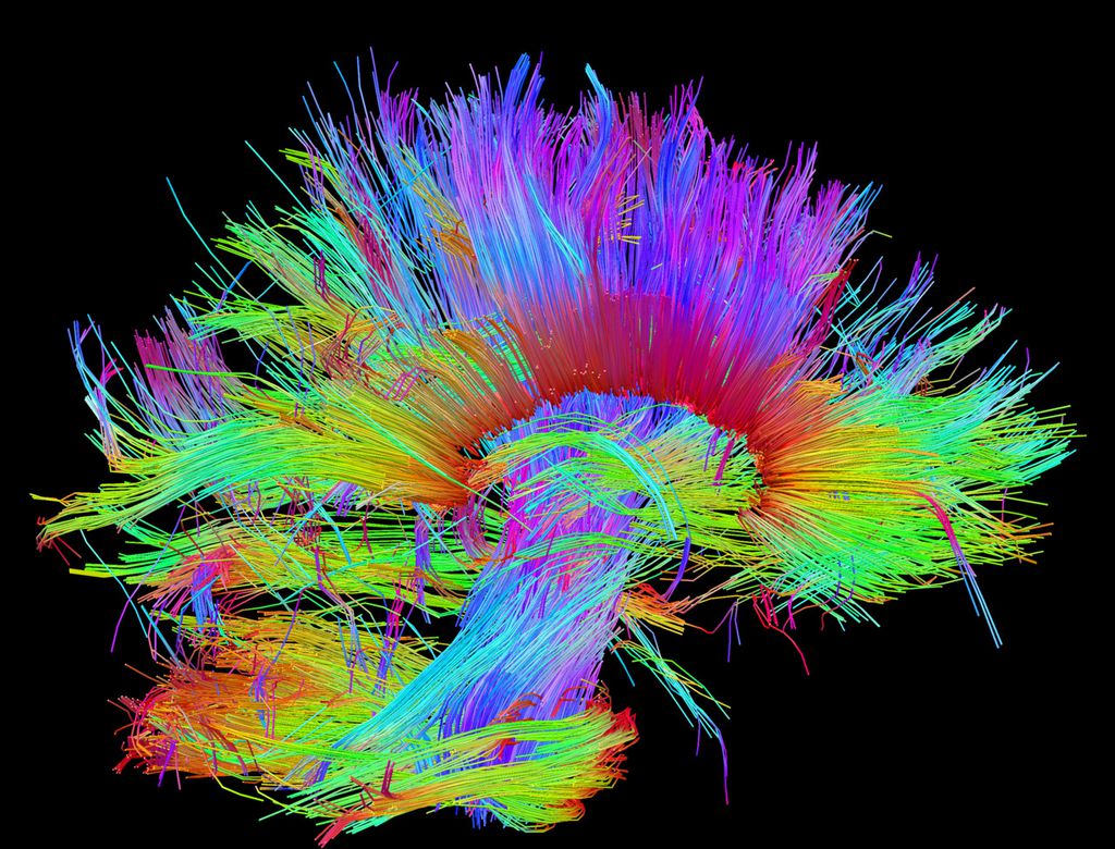 IA mapeia cérebro de crianças para identificar TDAH mais rápido (Foto: Reprodução/ Laboratory of Neuro Imaging )