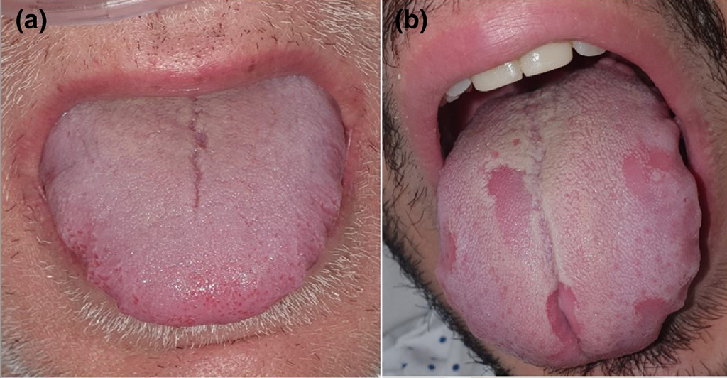 Pesquisa aponta para "língua de COVID-19" como mais um dos sintomas da infecção (Imagem: Reprodução/ Hospital La Paz/ British Journal of Dermatology)