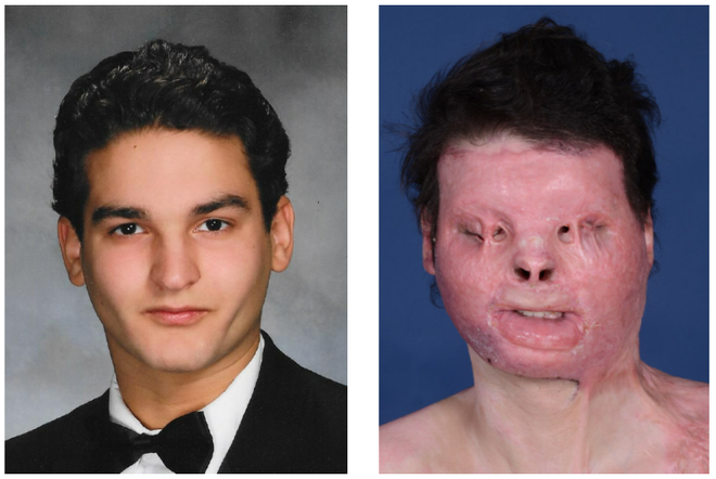 Imagens do paciente norte-americano antes do acidente e depois (Imagem: Reprodução/ NYU Langone Health)