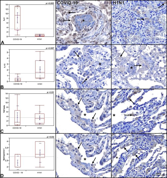 Pesquisadores da PUCPR compararam seis amostras de tecidos pulmonares com COVID-19 e H1N1. Na imagem, você vê fotomicrografias que exibem macrófagos atuando nas amostras dos pulmões (bolinhas azuis), enquanto os asteriscos mostram formação de fibrose (em cinza) ou a luz natural do alvéolo (em branco) (Imagem: Divulgação/PUCPR)