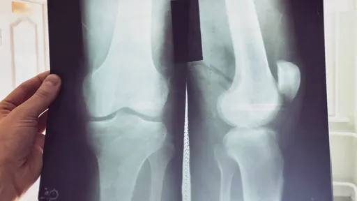 Pesquisadores desenvolvem lubrificante sintético para articulação dos joelhos