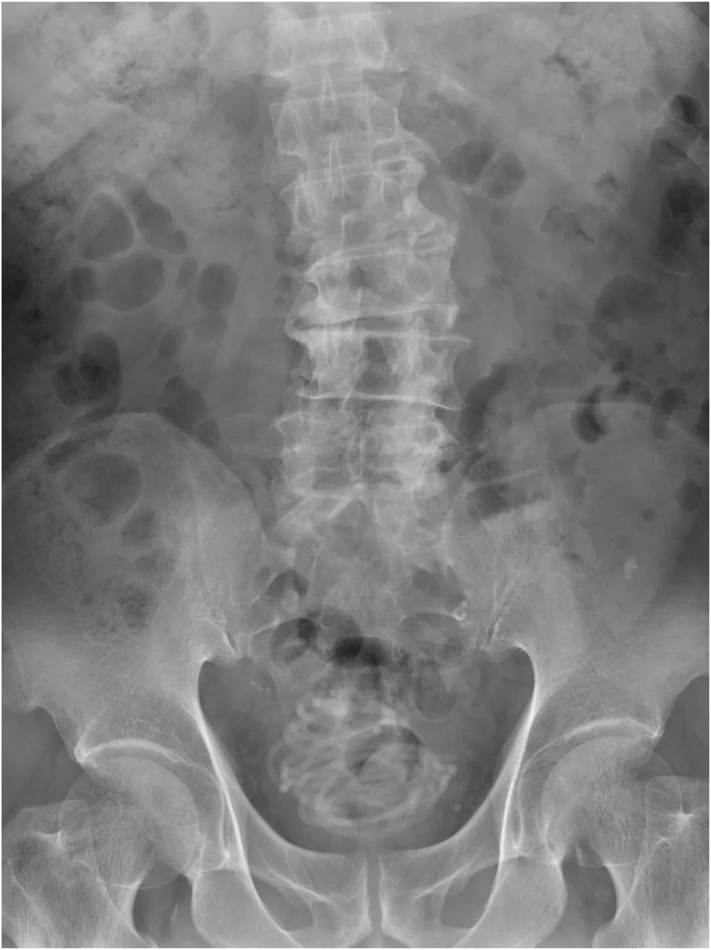 Raio-x do paciente, onde se pode ver o objeto no interior da bexiga (Imagem: Yokoyama et al./Urology Case Reports)