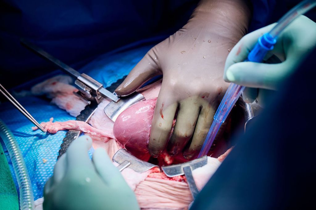 Paciente recebe coração mecânico e dias depois transplante com rim de porco (Imagem: Divulgação/NYU Langone Health)