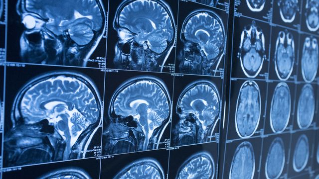 Quantos anos tem seu cérebro? Cientistas treinam IA para revelar idade cerebral