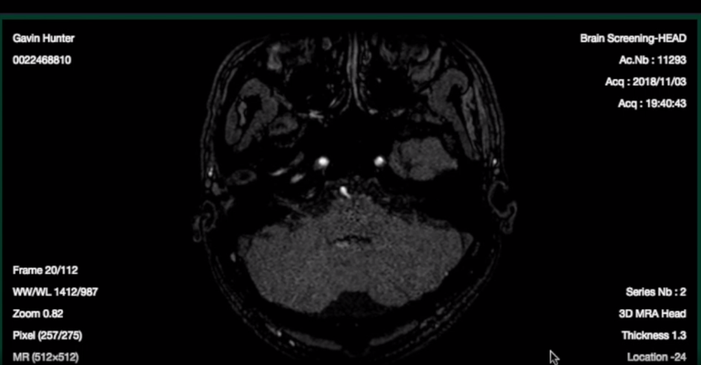 Exame cerebral que será analisado pelo EIRL pode prever aneurismas cerebrais (Fonte: EIRL)