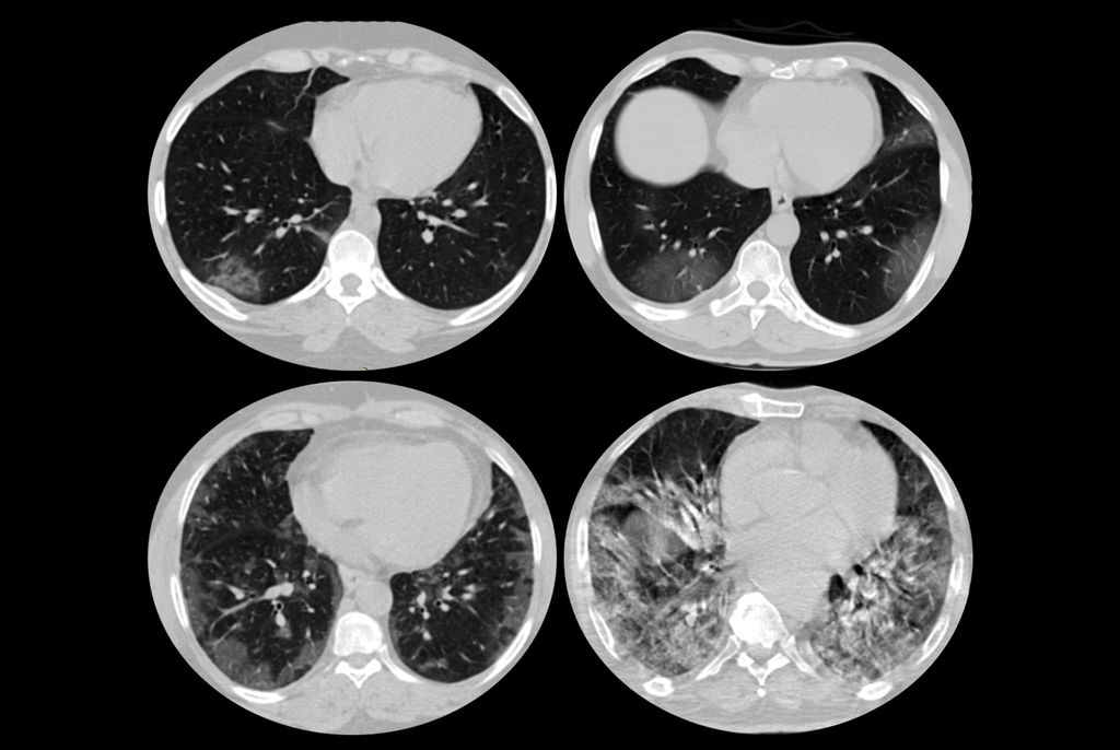 Exemplo de uma tomografia de pulmão (vista sagital)