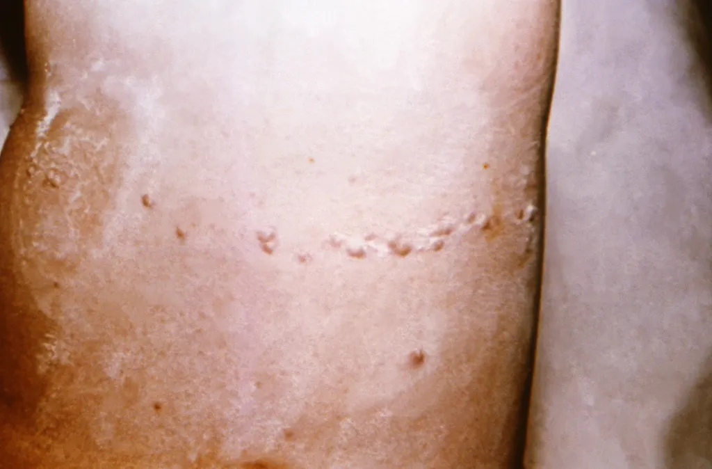Estudo sugere que a monkeypox pode ser transmitida antes dos primeiros sintomas e sinais, como as erupções na pele (Imagem: R. Robinson/CDC)