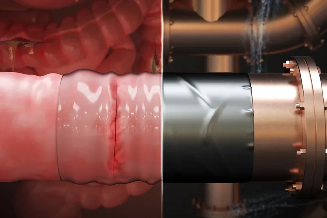 Cientistas criam fita adesiva cirúrgica para conter problemas no intestino (Imagem: Reprodução/MIT News)