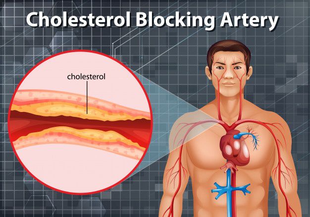 O colesterol pode se acumular nas artérias do coração e causar doenças cardíacas (Foto:brgfx / Freepik)