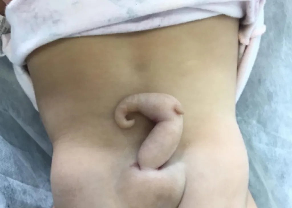Bebê nasce com cauda de 6 centímetros no Brasil (Imagem: Cunha et al., 2023/Journal of Pediatric Surgery Case Reports)