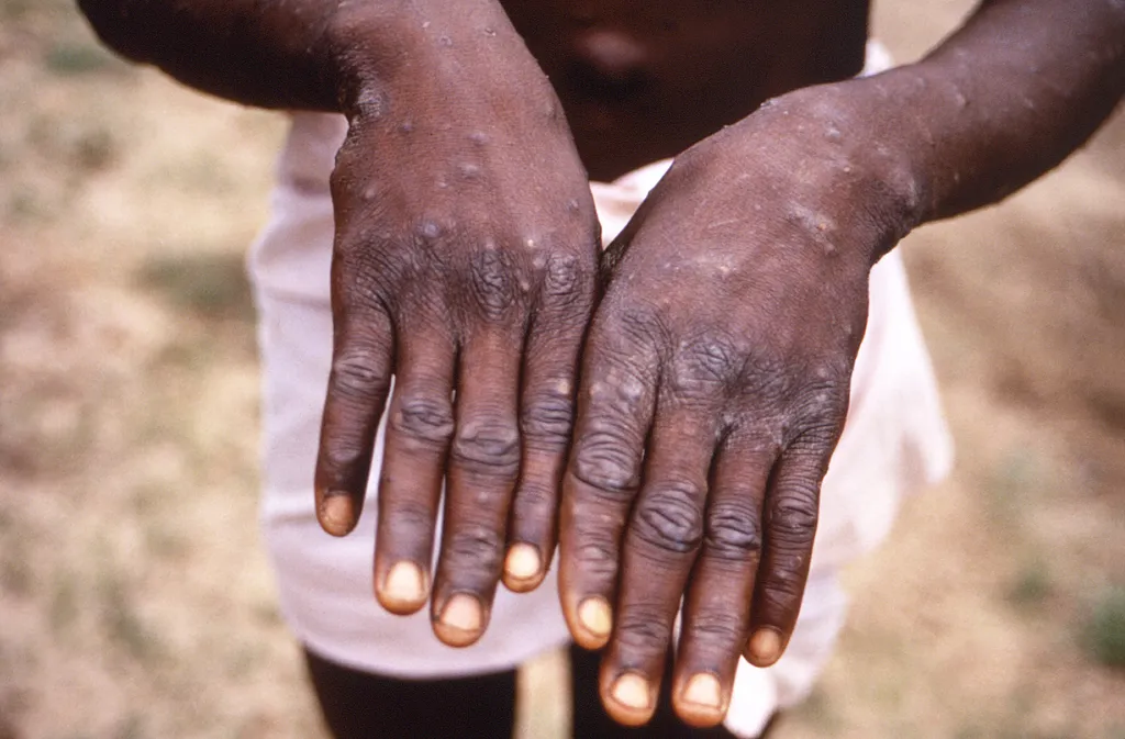 Erupções na pele são o principal sintoma da varíola dos macacos em humanos (Imagem: Brian W.J. Mahy/CDC)