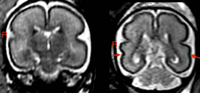 Na primeira imagem (esquerda), é possível observar o cérebro de um bebê exposto ao álcool. Na imagem ao lado (direta), está o cérebro de um feto saudável, que está mais desenvolvido e com cavidades mais organizadas (Imagem: Reprodução/RSNA e Patric Kienast, MD)