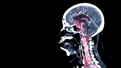 IA consegue prever se você terá aneurismas cerebrais; mas é seguro usá-la?