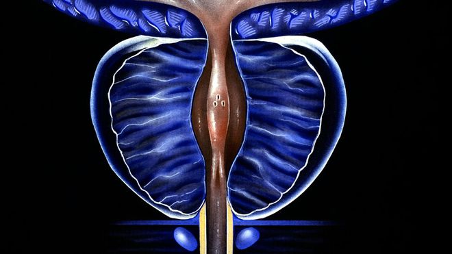 Imagem da próstata que pode ser simulada com IA (Fonte: Medscape)