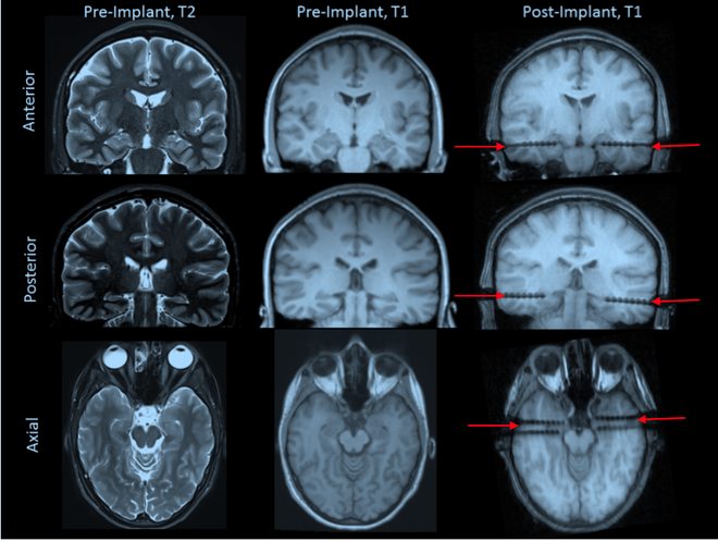 Tomografia: os cortes axiais, posteriores e anteriores mostram o cérebro antes e depois dos implantes (flechas vermelhas) nos pacientes submetidos ao estudo (Hampson et al., 2019)