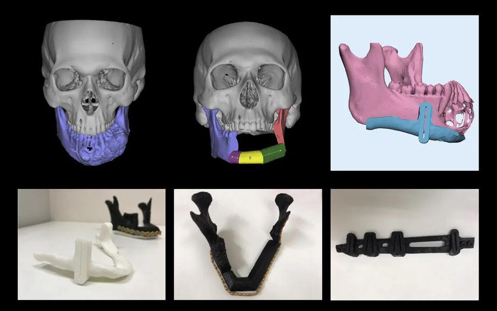 Processo de confecção do modelo e da prótese mandibular impressa em 3D aqui no Brasil (Imagem: Reprodução/Jornal da USP)