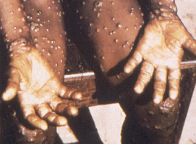 Marcados pelas erupções na pele, mais de mil casos da varíola do macaco são investigados no Congo (Imagem: Brian W.J. Mahy/OMS/CDC)