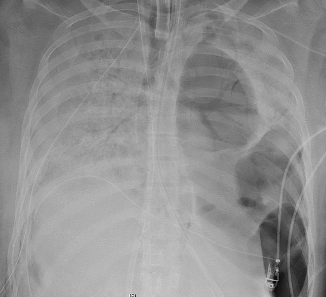 Paciente com COVID-19 em estado grave passa por transplante duplo de pulmão