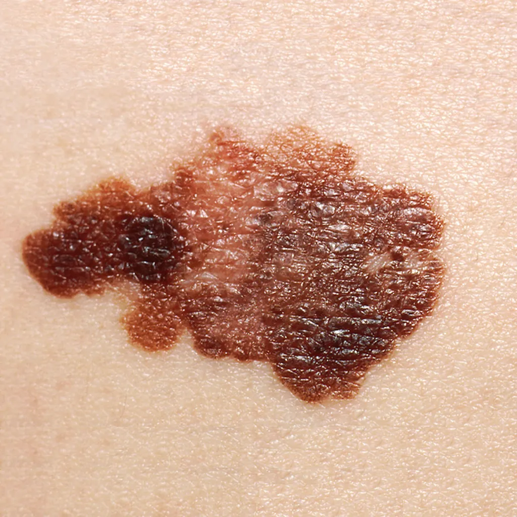 Vacina de mRNA contra o câncer de pele tem resultados promissores e vai entrar na última fase de pesquisa (Imagem: National Cancer Institute/CDC)
