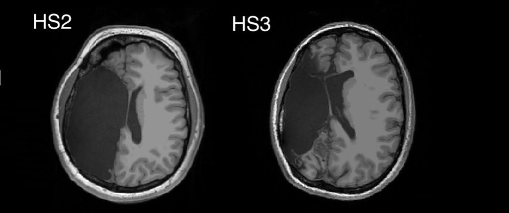 Ressonância magnética do cérebro após a cirurgia e, ao lado, na idade adulta (Fonte: Cell Reports)