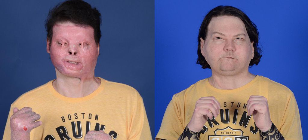 Antes e depois da operação de transplante simultâneo de face e mãos (Imagem: Reprodução/ Reprodução/ NYU Langone Health)