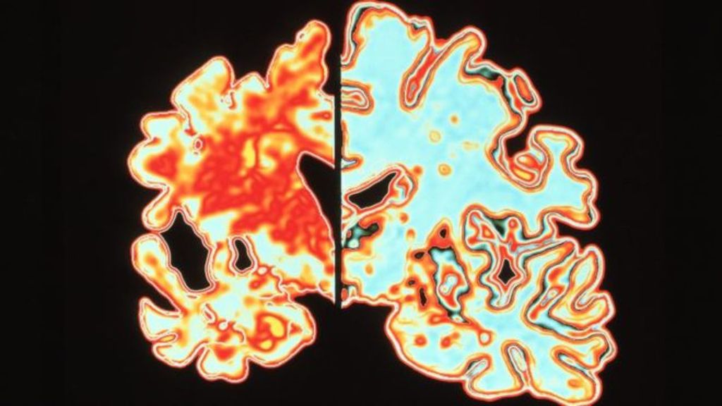 Comparação entre o cérebro paciente diagnosticado com doença de Alzheimer (esquerda) comparado a um não (direita) (Foto: Divulgação/ Science Photo Library)
