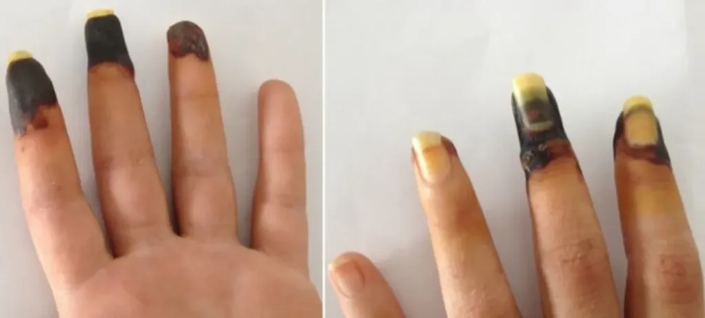 Cannabis deixa homem com dedos roxos em raríssimo efeito colateral (Imagem: Reprodução/Annals of Emergency Medicine)