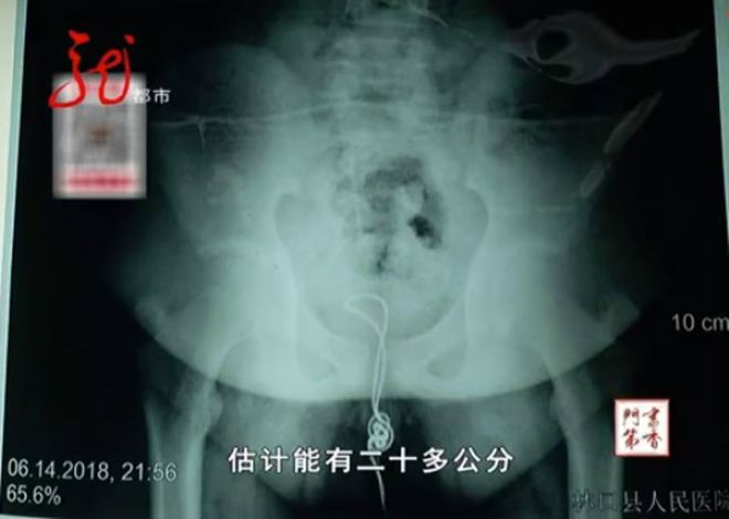 Raio X do jovem de 13 anos que enfiou um cabo USB no próprio pênis (Imagem: Reprodução / Harbin Hospital)