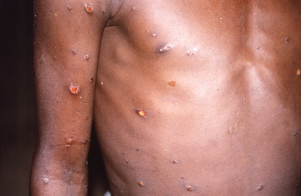 Feridas causadas pela varíola dos macacos (Imagem: CDC/Brian W.J. Mahy)