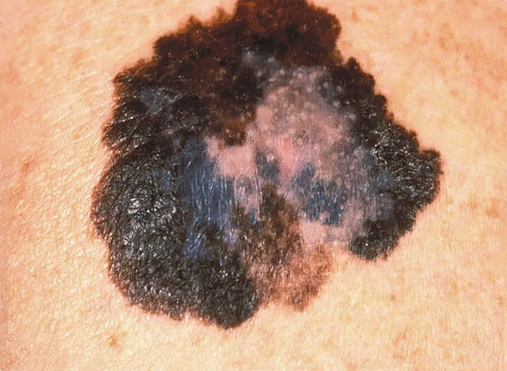 Molécula brasileira pode ser alternativa para o tratamento do câncer de pele mais agressivo, o melanoma (Imagem: CDC/Carl Washington/Mona Saraiya)