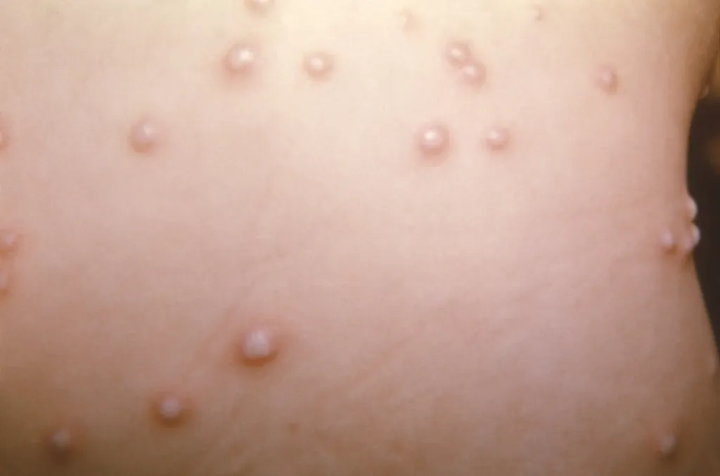 A varíola dos macacos se caracteriza principalmente pelas marcas espalhadas na pele (Imagem: Dr. Noble/CDC)