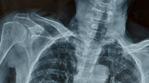 Microrrobô injetável pode desenvolver ossos para tratar fraturas
