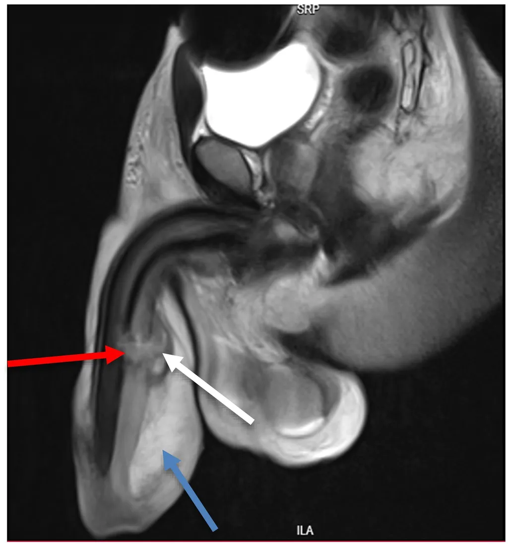 Além de quebrar o pênis em três partes, os médicos identificaram lesão na uretra (seta vermelha), edema (azul) e hematoma (branca) / Imagem: Ngowi et al.,2023/Int J Surg Case Rep)
