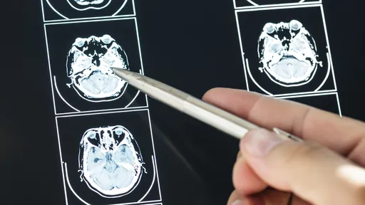 No futuro, médicos diagnosticarão demência usando inteligência artificial