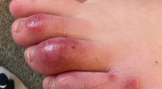 "Dedos de COVID" podem ser um dos sintomas da infecção (Imagem: Reprodução/WBRC)