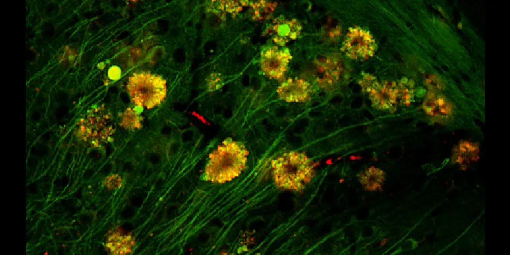 "Flores venenosas", vacúolos inchados ao redor dos neurônios de camundongos, como observado pelos cientistas (Imagem: Lee et al./Nature Neuroscience)