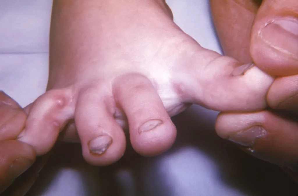 Transmissão da varíola dos macacos ocorre há mais de semanas, segundo a OMS (Imagem: K.L. Herrmann/CDC)