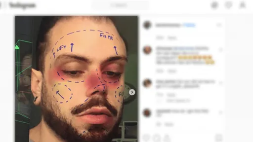 Instagram remove filtros que simulavam marcações de cirurgia plástica; entenda