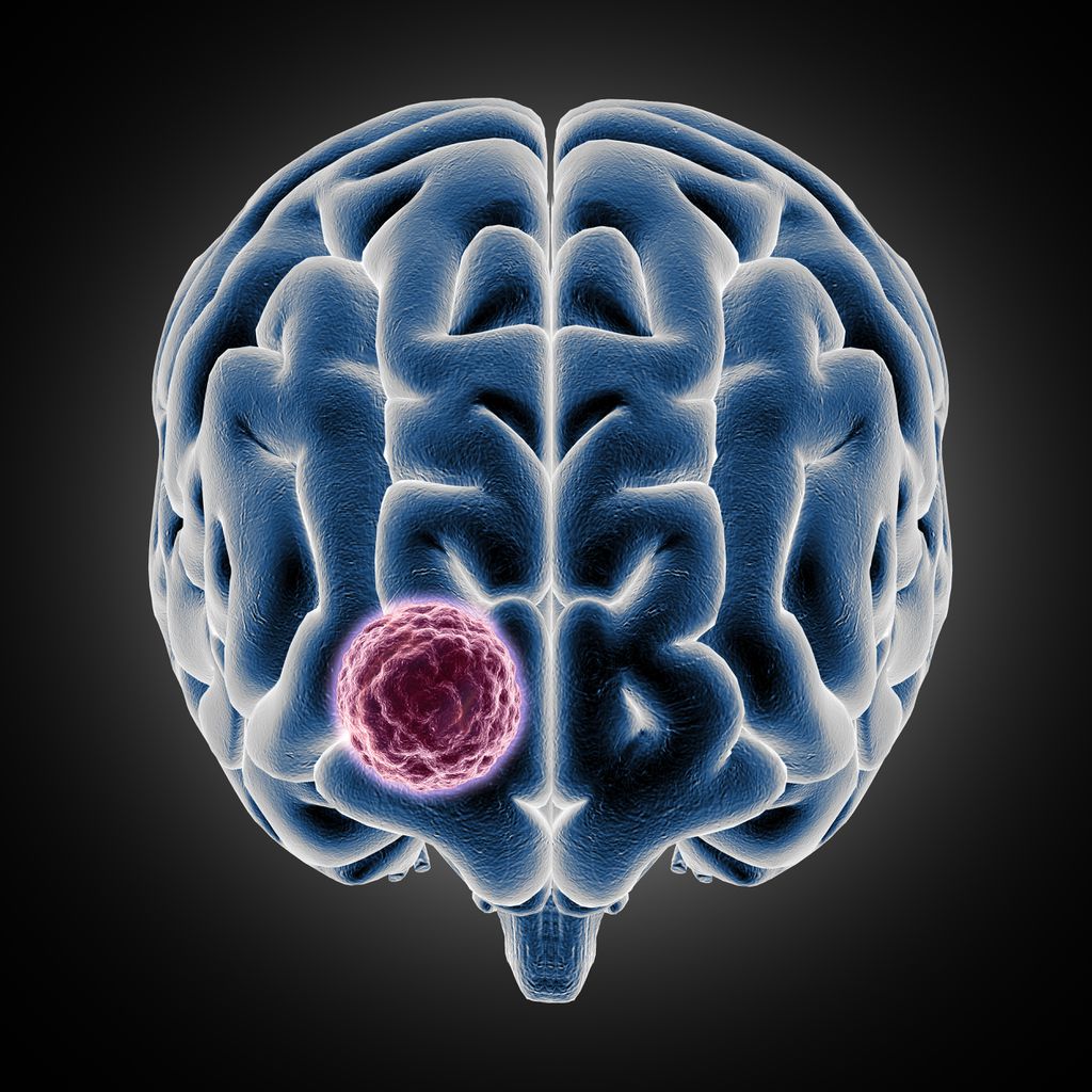Tumor cerebral | Sintomas, gravidade e tratamento de tumores malignos e benignos