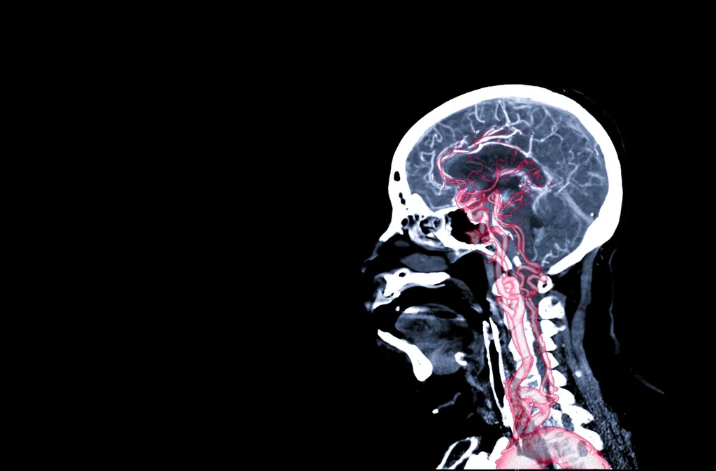 Aneurismas podem ser causados pela vasculite, mas é bom lembrar que eles não necessariamente ocorrem no cérebro (Imagem: Meritage Medical)