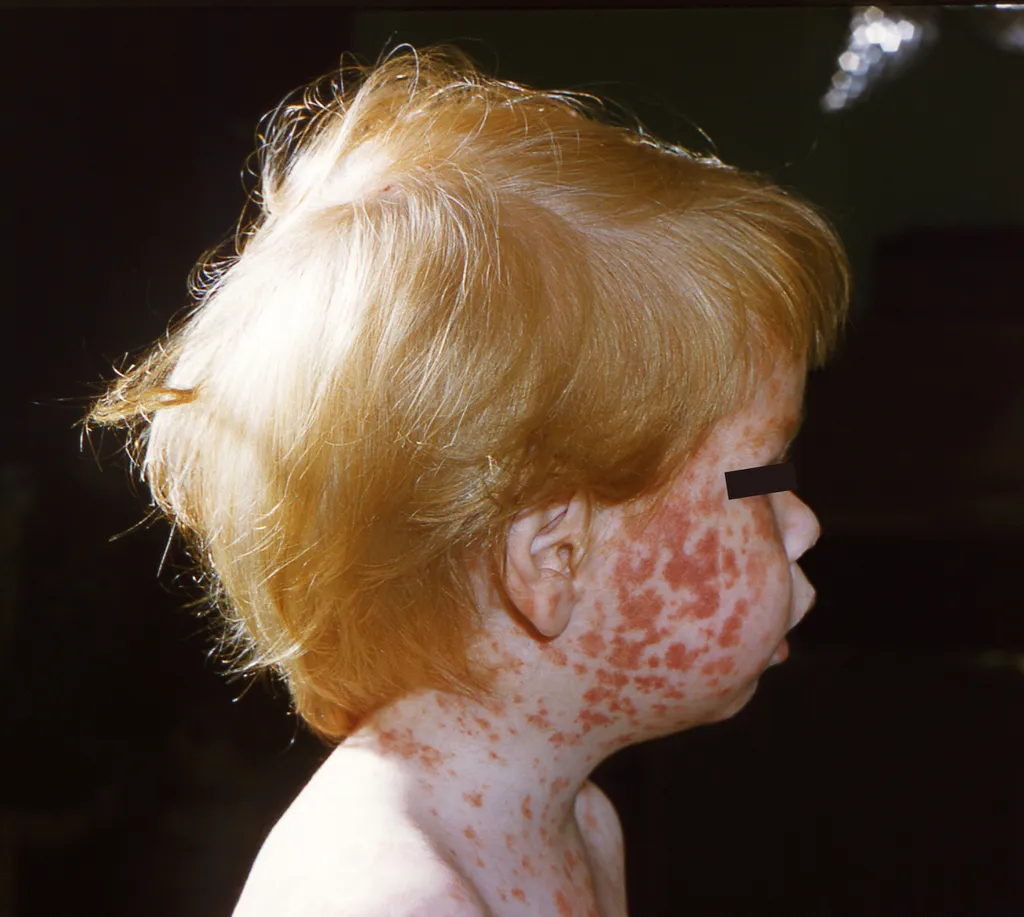 O sarampo pode ser uma doença bastante grave, principalmente em crianças com menos de 5 anos (Imagem: Reprodução/CDC)