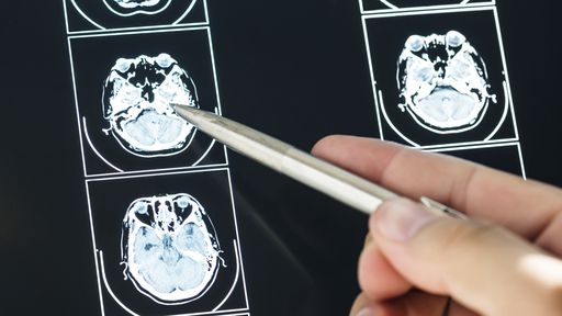 Diurético se mostra promissor e vira nova esperança no tratamento do Alzheimer