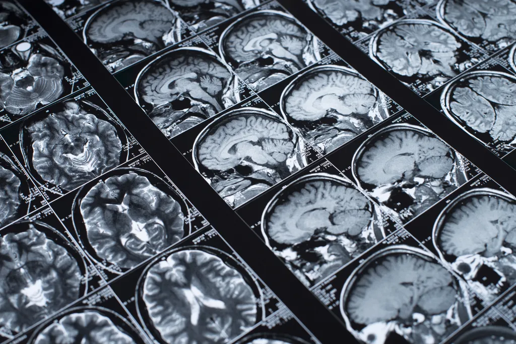A amígdala, parte do cérebro que controla ansiedade, medo e comportamento em relação ao álcool, foi alvo da edição genética dos cientistas (Imagem: alexstand/envato)