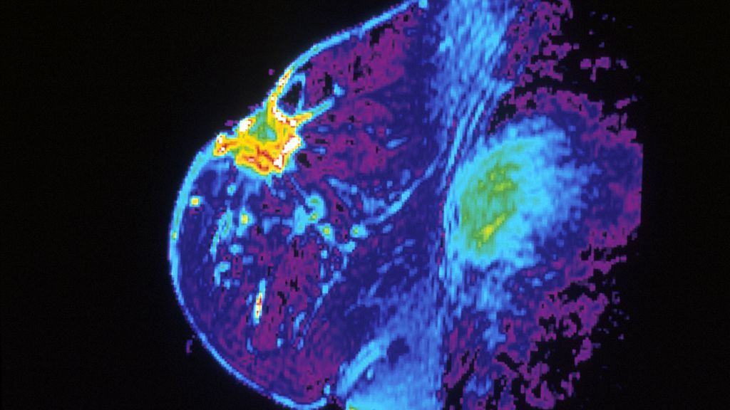 Em treinamento, ferramenta com IA pode ler exames e identificar mais rápido vários casos de câncer de mama