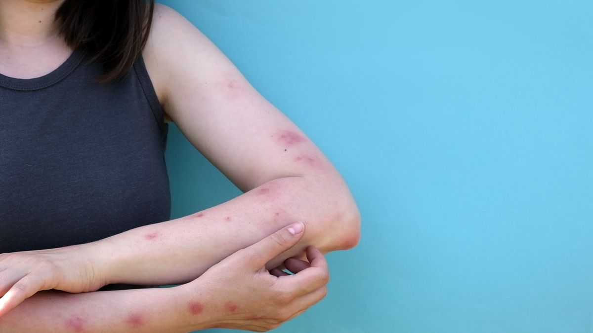 Dois estados brasileiros registram casos de mpox; nova cepa 1b chega ao país