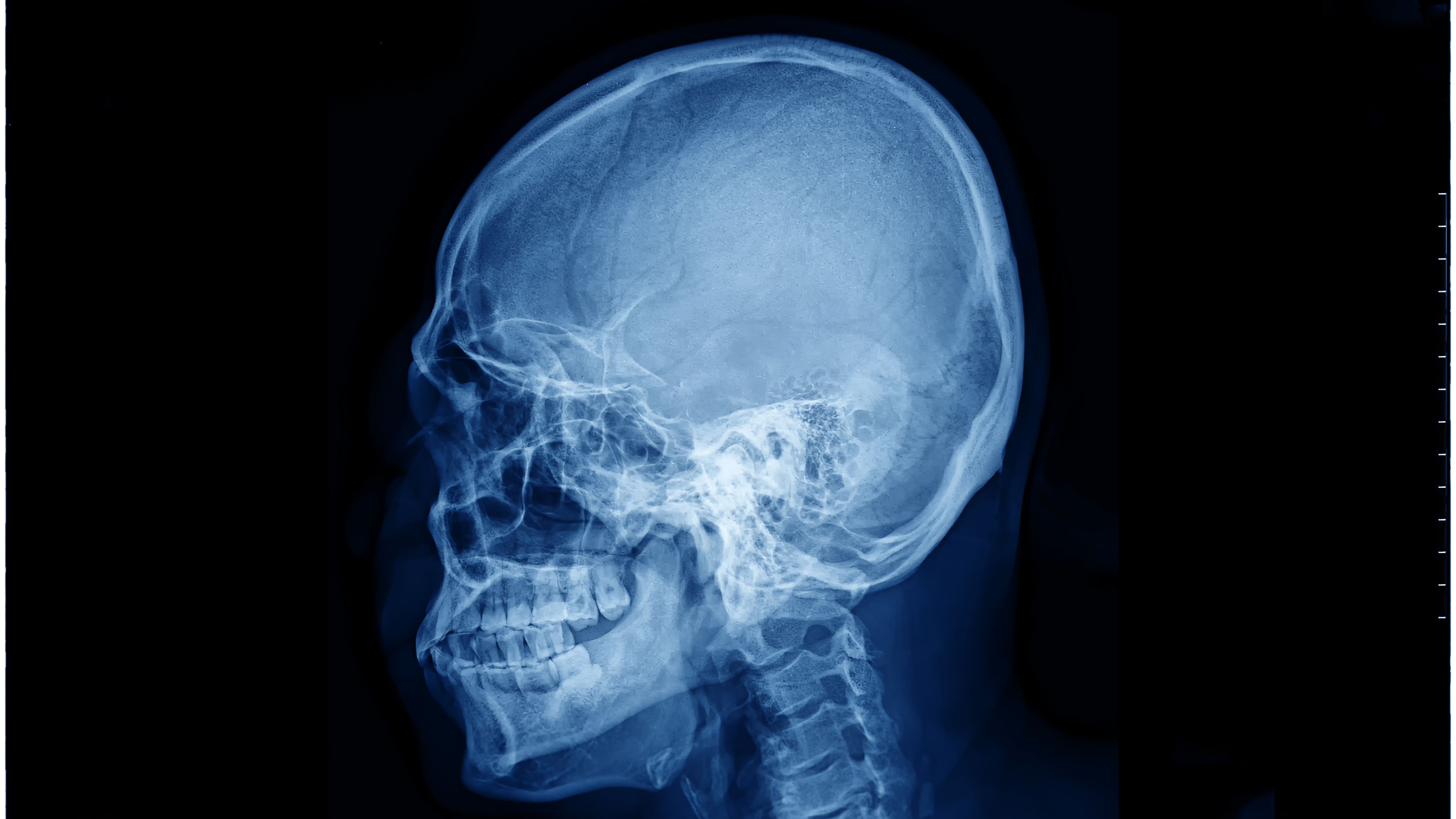 Детский череп рентген. Тангенциальный рентген черепа.