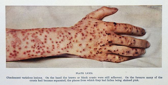 A Revolta da Vacina teve como principais motivos a vacinação contra a varíola (Imagem: Reprodução/ Wellcome Library London/ Wikipédia)