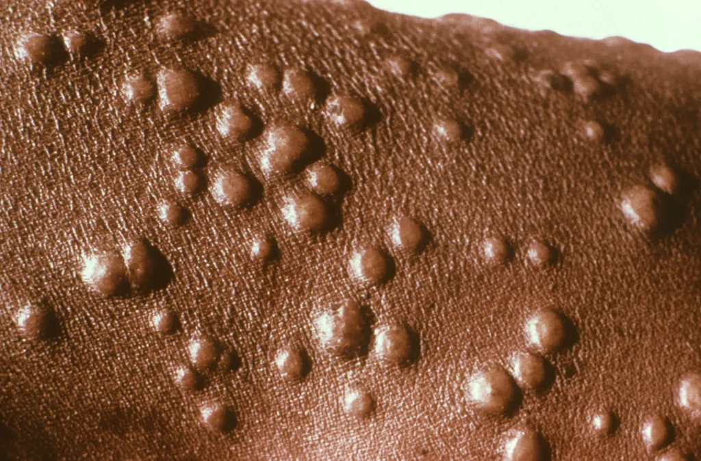 Varíola dos macacos tem taxa de letalidade inferior que a da varíola comum (Imagem: Paul B. Dean/CDC)