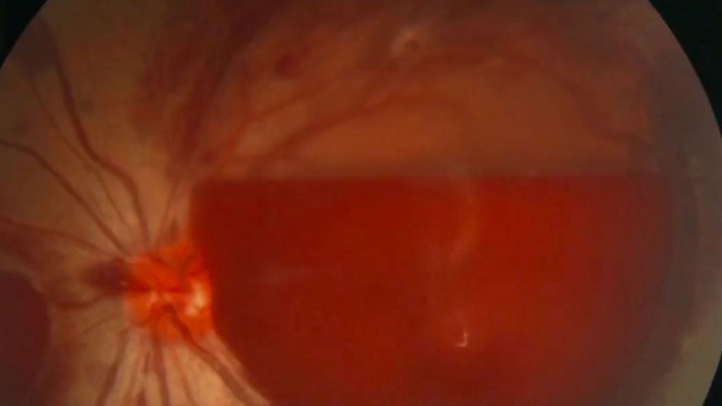 Imagem mostrando o vaso estourado da paciente: a mancha mais escura consiste de sangue barrando a visão dela, devido ao uso contínuo e excessivo do smartphone (Imagem: Reprodução/AsiaWire)